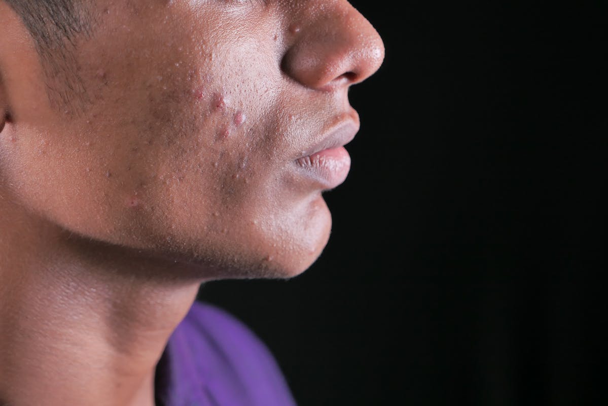 Side view close-up of a young man's face with visible acne on cheek and jawline.